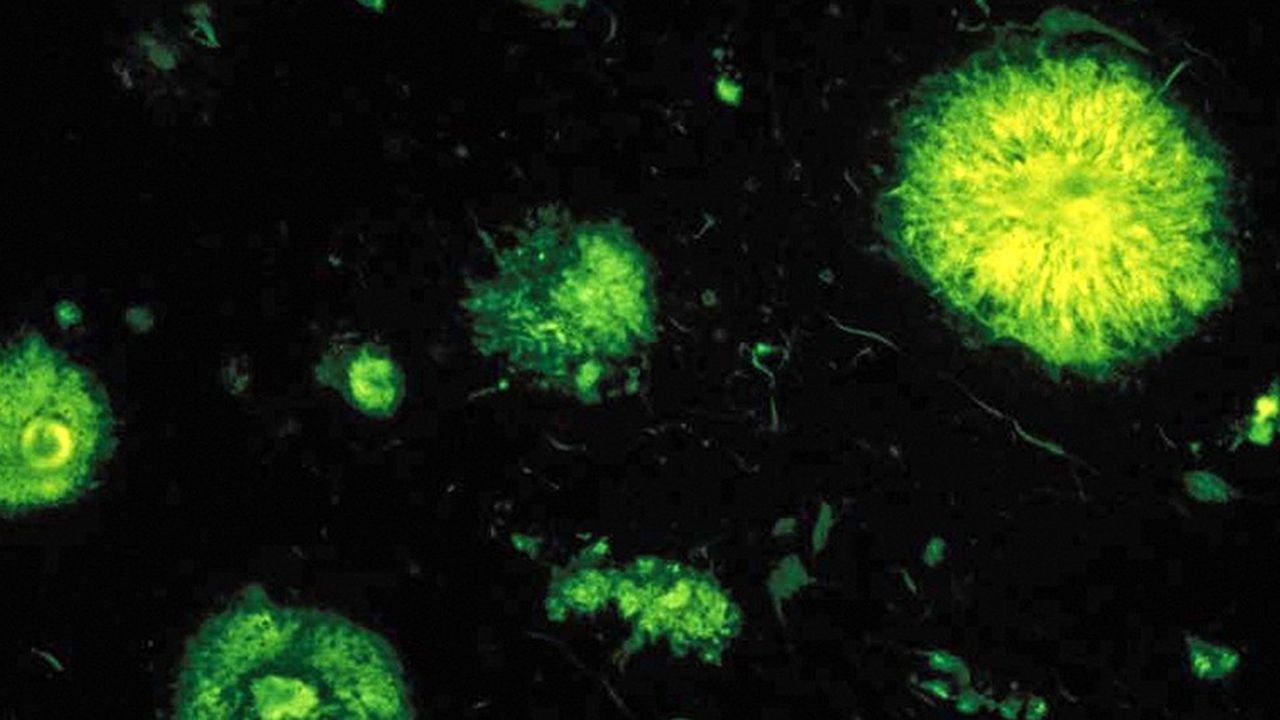 Plaques séniles, ou plaques amyloïdes, observées en fluorescence dans un cas de maladie d'Alzheimer.