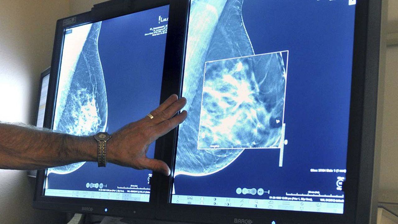 Le système de Therapixel permet de détecter le cancer du sein avec une pertinence supérieure ou égale à celle des médecins.