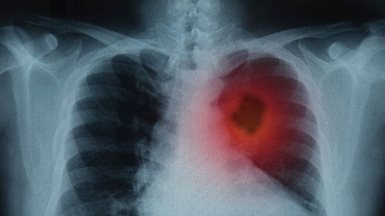 Selon le rapport, l'incidence du cancer du poumon diminue deux fois plus rapidement chez les hommes que chez les femmes.