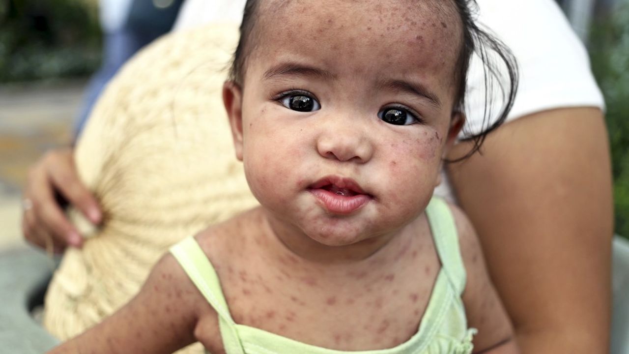 Une petite fille des Philippines, en février dernier, atteinte de la rougeole. 