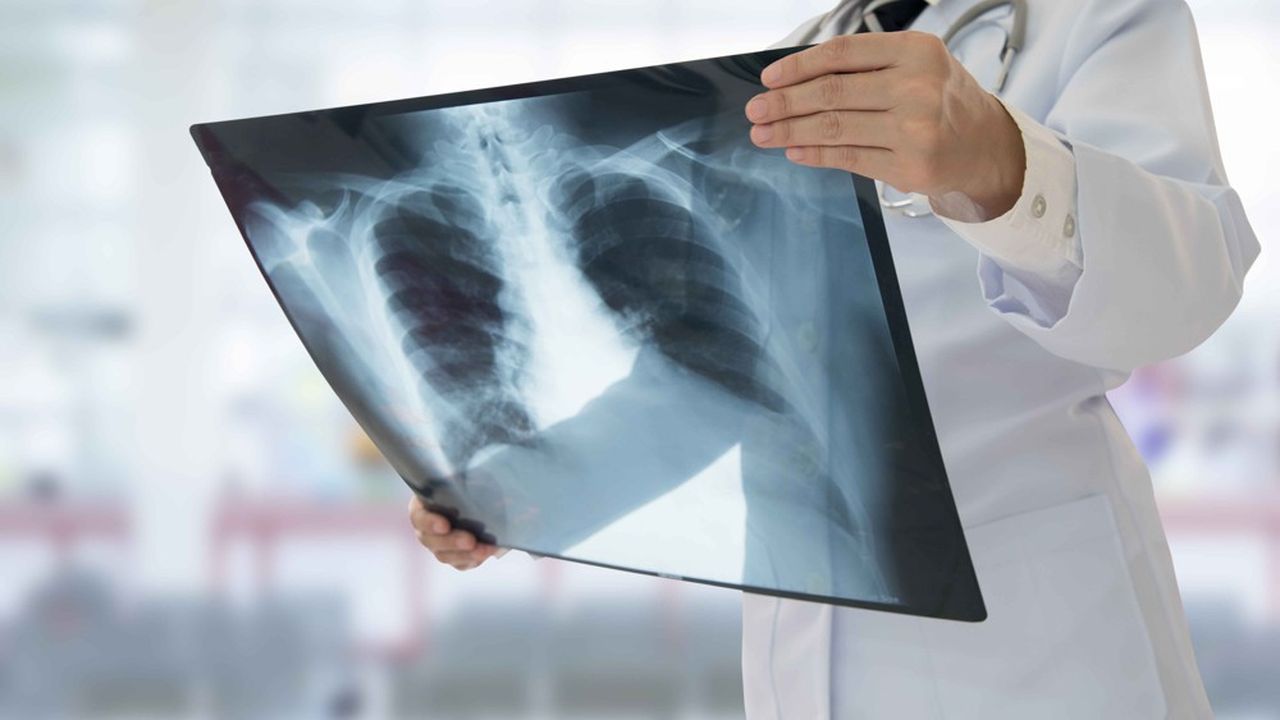 La tuberculose est une infection touchant le plus souvent les poumons, transmise par voie aérienne et qui peut se propager au cerveau.