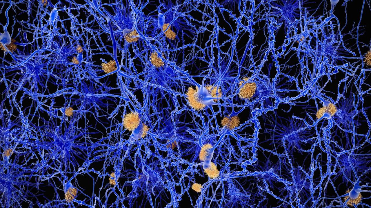 Les plaques amyloïdes (ici en jaune orangé) qui se forment entre les neurones (en bleu) constituent, avec les neurodégénérescences fibrillaires, l'une des deux lésions caractéristiques de la maladie d'Alzheimer.