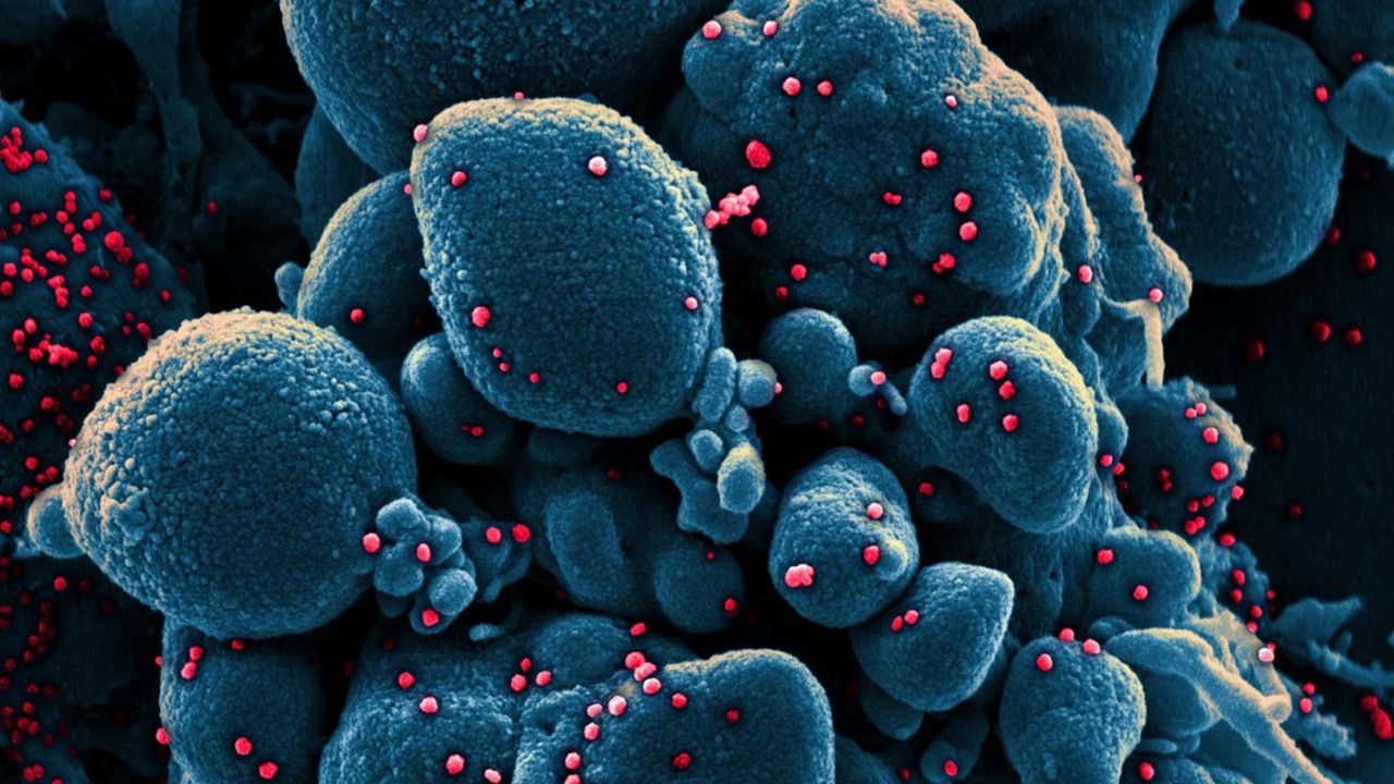 Vue colorisée d'une cellule apoptotique (bleue) infectée par des particules du virus SARS-CoV-2 (rouge).
