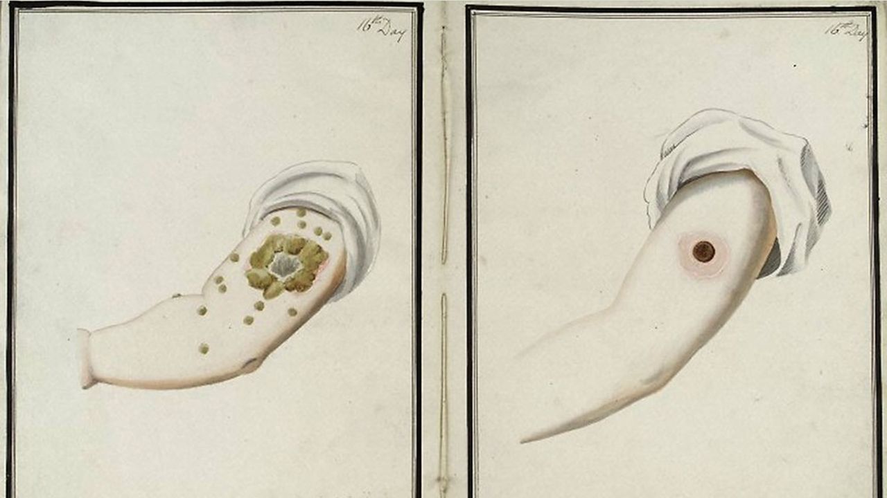 Gravure de 1802 : comparaison de la variole (à gauche) et la vaccine (à droite) 16 jours après l'inoculation.