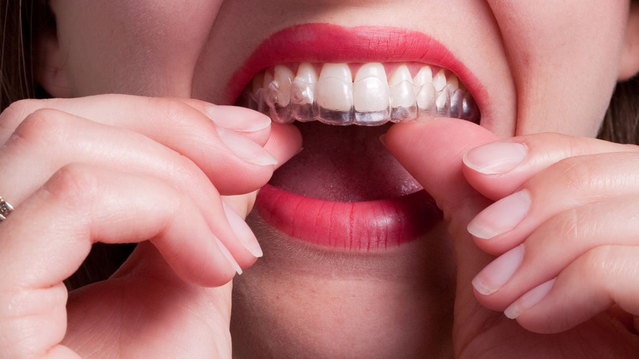 Selon un sondage, 54 % des Français interrogés aimeraient avoir des dents mieux alignées, 43 % avouent avoir déjà caché leurs dents au moment de sourire.