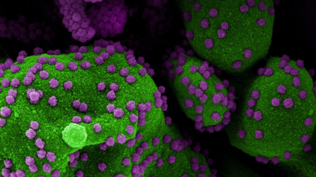 Des cellules (en vert) massivement infectées par le coronavirus SARS-CoV-2 (en violet), vues au microscope électronique.