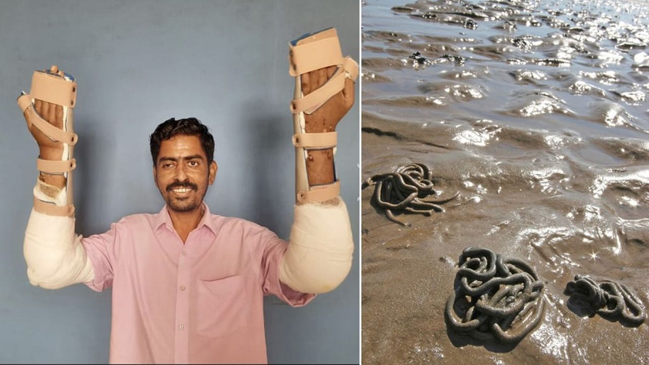 Grâce au transporteur d'oxygène mis au point par la société Hemarina à partir d'hémoglobine de ver marin, le patient indien de 34 ans a pu bénéficier d'une double greffe des avant-bras dans de bonnes conditions