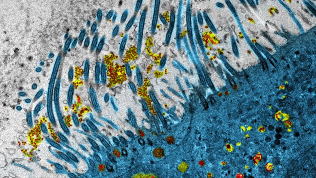 Image d'un épithélium respiratoire humain infecté par le Sars-CoV-2, obtenue par microscopie électronique à transmission sur la plateforme d'imagerie de l'Université Claude Bernard Lyon 1.