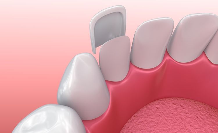 Les facettes dentaires sont collées à l'avant des dents, qui peuvent être très légèrement limées avant la pose.
