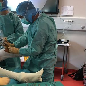 Les implants de SBM permettent de restaurer des articulations sans prothèse, comme dans cette intervention de Nicolas Graveleau à la Clinique du sport Bordeaux-Mérignac