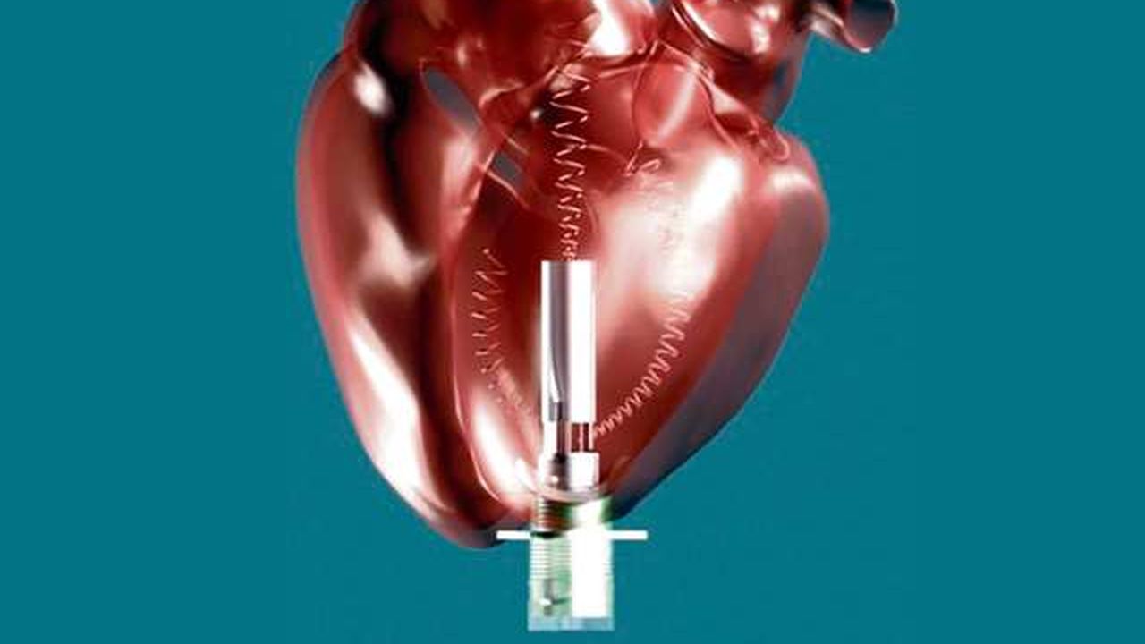 La pompe cardiaque de FineHeart s'adresse à des patients dont le coeur est affaibli mais fonctionne ; un marché annuel potentiel de 170.000 patients.