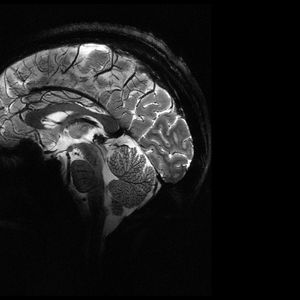Coupe sagittale du cerveau (traversant le cerveau d'avant en arrière) obtenue avec l'IRM Iseult à 11,7 tesla.