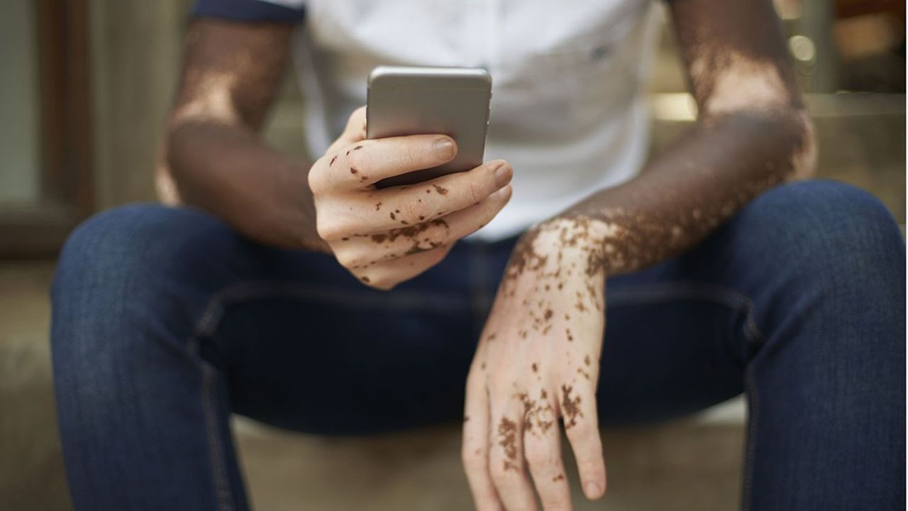 Vitiligo : le premier traitement arrive pour le million de Français touchés par cette maladie de la peau